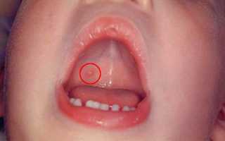 Как распознать и чем лечить герпес во рту у ребёнка