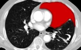 Рентгенодиагностика пневмоторакса