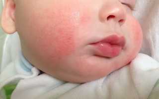 Аллергия у новорожденного при грудном вскармливании что делать