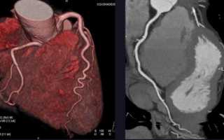 Коронарная ангиография – эффективная диагностика болезней сердца