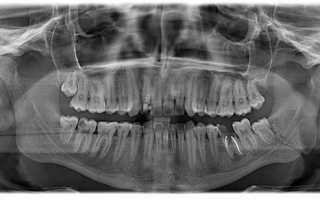 Рентгенологическое исследование верхней и нижней челюсти