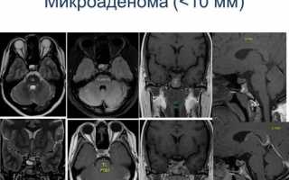 Магнитно-резонансная томография: единственный метод в диагностике микроаденом