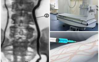 Рентген в диагностике патологии почек: экскреторная урография и ее возможности