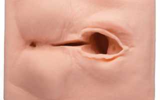 Эпизиотомия при родах