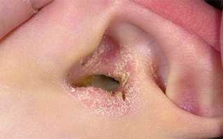 Симптомы и лечение герпеса на внешней стороне уха и внутри ушной раковины