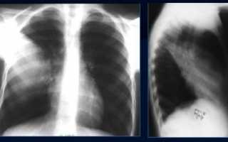 Рентгенологическое исследование легких – доступный и информативный метод диагностики