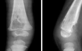 Рентгенологическая диагностика остеомиелита