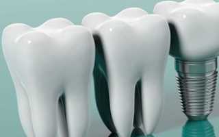 Имплантация зубов: показания, противопоказания, плюсы и минусы