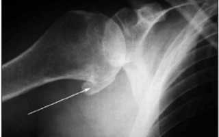 Рентген-исследование плечевого сустава: диагностические возможности, методика, показания