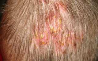 Симптомы и лечение герпеса на голове в волосах при ВПГ и опоясывающем лишае