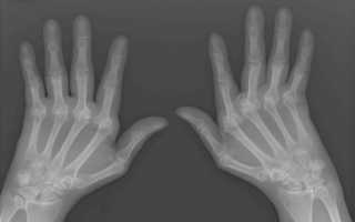 Рентгенографическая диагностика ревматоидных артритов