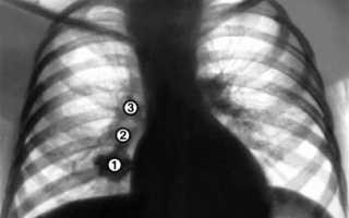 Выявление туберкулеза с помощью рентгенографии