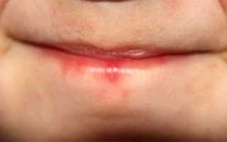 Герпес на губах у ребенка — особенности герпетической инфекции у детей