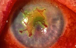 Клиническая картина и правильное лечение герпетического кератита — как не потерять зрение