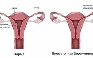 Внематочная беременность и лапароскопия: подготовка, методика проведения и последствия