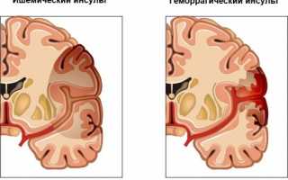 Результат МРТ головного мозга: норма и патология