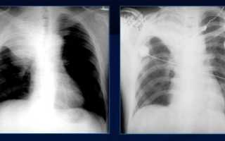 Симптомы и дифференциальная диагностика ателектазов на рентгенограмме