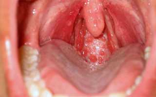 Симптомы и лечение герпеса в горле у взрослых и как отличить герпетическую инфекцию от других