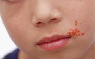 Подробная клиническая картина герпеса на лице у ребёнка — как выглядит и чем лечить