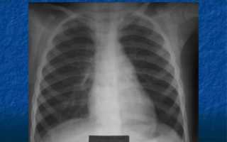 Как выглядит рентгеновский снимок легких в норме
