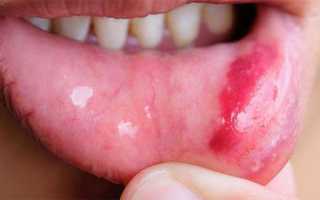 Герпес на внутренней стороне губы — 4 стадии развития и правильные методы лечения