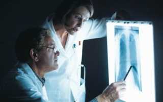 Рентген – ведущий метод диагностики пневмонии