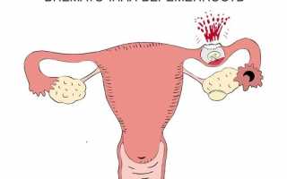 Выявление внематочной беременности на УЗИ