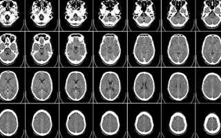 Компьютерная томография черепа: показания, возможности диагностики