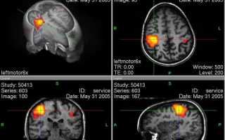 Магнитно-резонансная томография: информативная нейровизуализационная методика обследования головного мозга