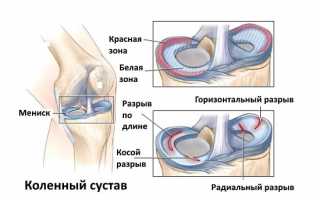 Артроскопическое лечение коленного сустава: показания и противопоказания, особенности проведения и восстановления