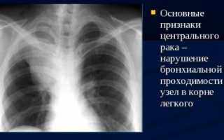 Рентгенодиагностика рака легких: методы и возможности