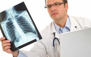 Что может показывать рентген легких?