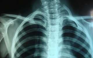 Рентген-исследование ребер, как оптимальный метод диагностики