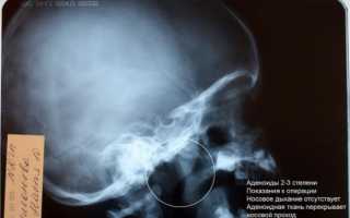 Рентгенологический метод исследования носоглотки: преимущества и недостатки