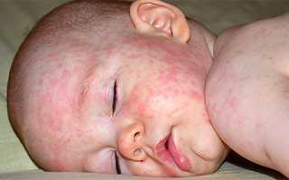 Симптомы и лечение детской розеолы у детей