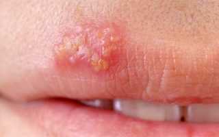 ВПГ 1 и 2 типа (herpes simplex) — что это такое и как лечить вирус простого герпеса