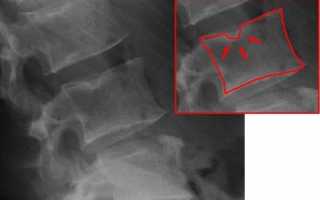 Рентген позвоночника: основа современной диагностики поражений опорно-двигательного аппарата