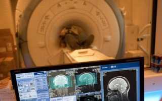 МРТ при диагностике и мониторинге рассеянного склероза
