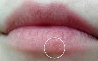 Как быстро вылечить герпес на губах — самые эффективные методы лечения простуды