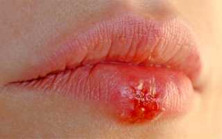 Профилактика герпеса (простуды) на губах