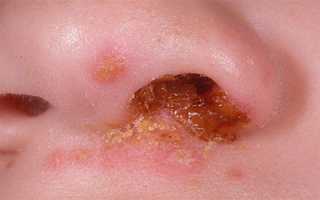 Симптомы и лечение герпеса в носу — особенности герпетической инфекции на слизистой оболочке