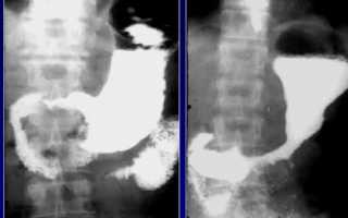 Особенности проведения рентгенографии желудка, двенадцатиперстной кишки и других отделов ЖКТ