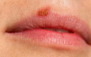 4 способа передачи герпеса на губах от человека к человеку и период заразности