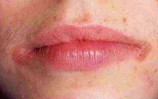 Симптомы и лечение герпеса в уголках губ