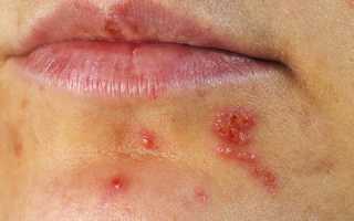 Как лечить герпес на лице при разных типах герпесвируса — самый правильный подход